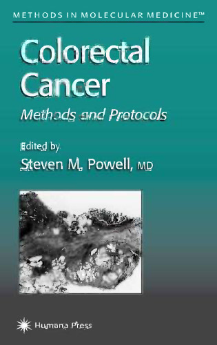 سرطان کولورکتال: روش ها و پروتکل ها
