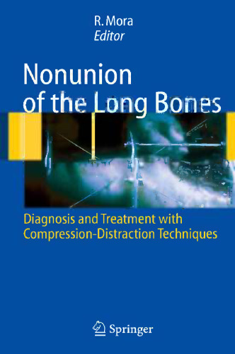 Nonunion of the Bones Long: تشخیص و درمان با تکنیک های فشرده سازی-پریشانی