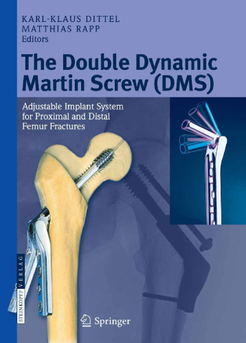 Double Dynamic Martin Screw (DMS): سیستم ایمپلنت قابل تنظیم برای شکستگی های استخوان ران و پروگزیمال