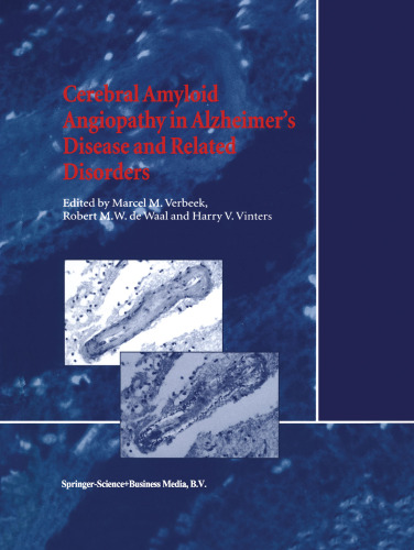 آنژیوپاتی آمیلوئید مغزی در بیماری آلزایمر و اختلالات مرتبط