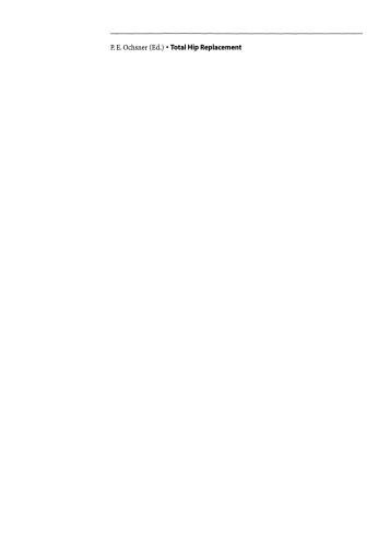 ﻿تعویض کامل هیپ: تکنیک کاشت و عوارض موضعی