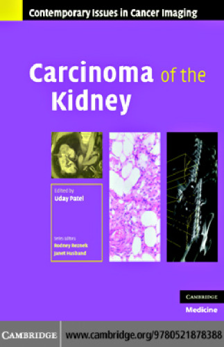 کارسینومای کلیه