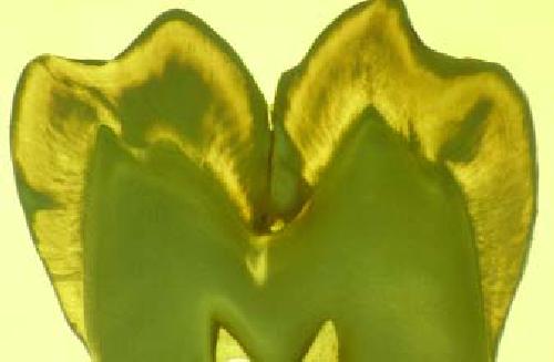 ﻿کلاس های پوسیدگی دندان