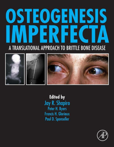 ﻿Osteogenesis Imperfecta: رویکرد ترجمه ای به بیماری شکننده استخوان