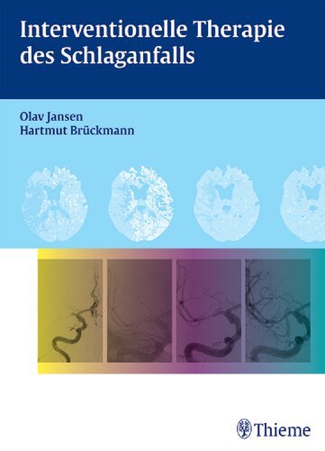 ﻿درمان مداخله ای برای سکته مغزی