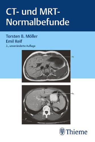 ﻿CT و MRI یافته های طبیعی است
