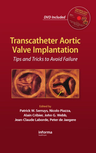 ایمپلنت دریچه آئورت Transcatheter: نکات و ترفندها برای جلوگیری از شکست