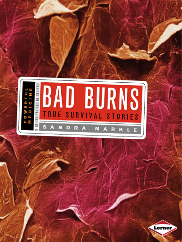 بد سوختگی: داستان های زنده ماندن واقعی