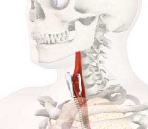 ﻿سرطان حنجره: مفاهیم فعلی در درمان گردن (ORL)