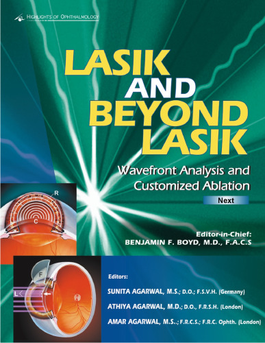 Lasik و آنالیز تجزیه و تحلیل Wavefront Lasik و Ablates سفارشی