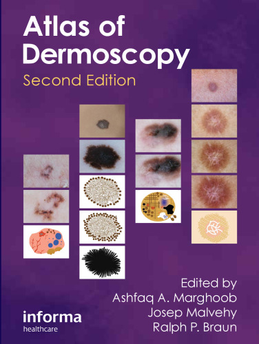 Atlas of dermoscopy