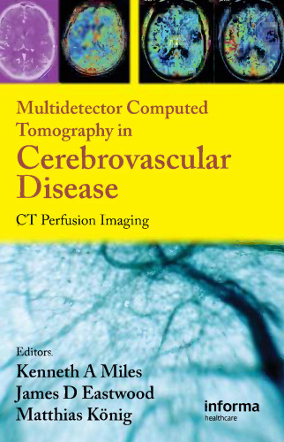 Multidetector computed tomography in cerebrovascular disease: CT perfusion imaging