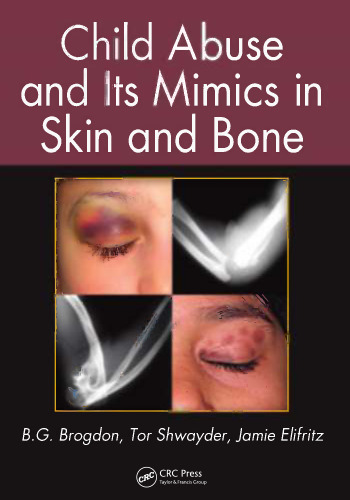 Child abuse and its mimics in skin and bone