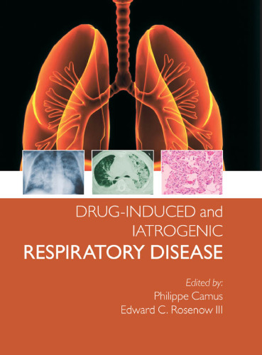 Drug-induced and iatrogenic respiratory disease