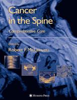 Cancer in the Spine: Comprehensive Care