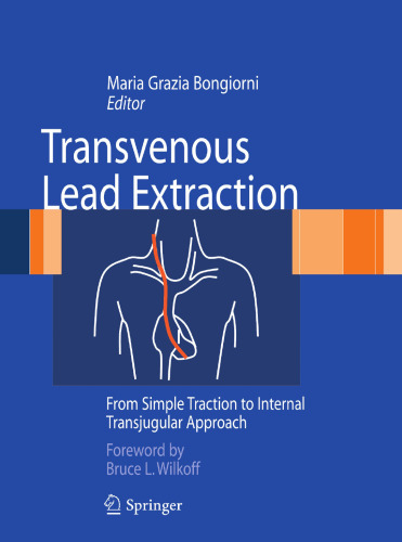 Transvenous Lead Extraction: From Simple Traction to Internal Transjugular Approach