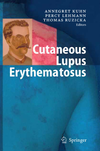Cutaneous Lupus Erythematosus