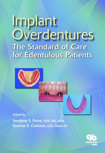 Implant Overdentures: The Standard of Care for Edentulous Patients