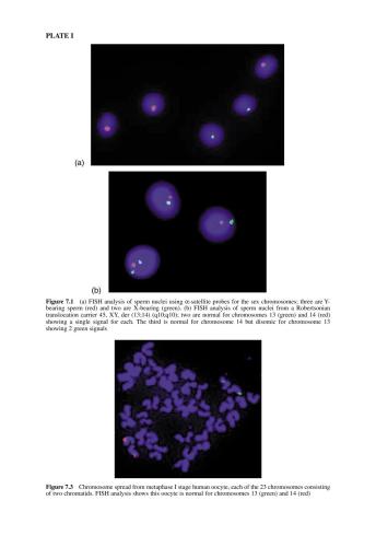 Preimplantation Genetic Diagnosis