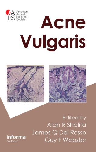 Acne Vulgaris
