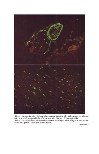 Herpes Simplex Varicella and Zoster. Clinical Manifestations and Treatment