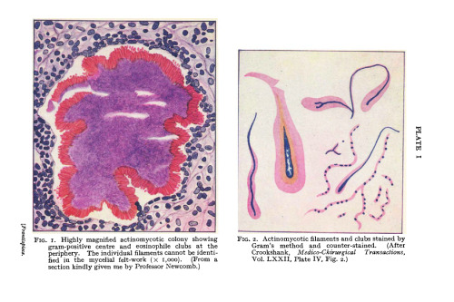 Human Actinomycosis. What the General Practitioner Ought to Know About