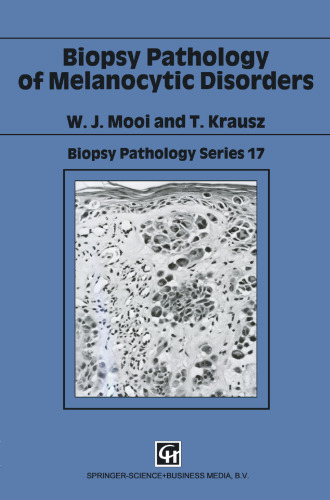 Biopsy Pathology of Melanocytic Disorders
