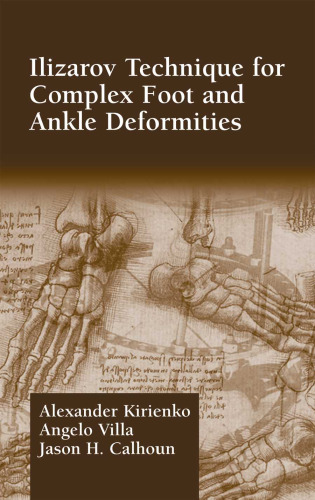 Alexander Kirienko Ilizarov Technique for Complex Foot and Ankle Deformities