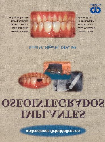 Aplicaciones Ortodвnticas en Implantes