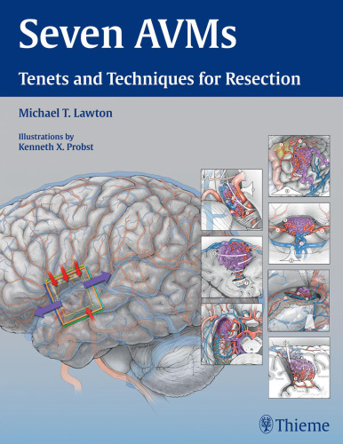 Seven AVMs: Tenets and Techniques for Resection