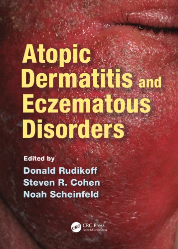 Atopic Dermatitis and Eczematous Disorders