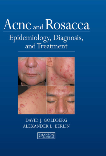 Acne and Rosacea: Epidemiology, Diagnosis and Treatment