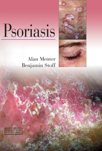Psoriasis