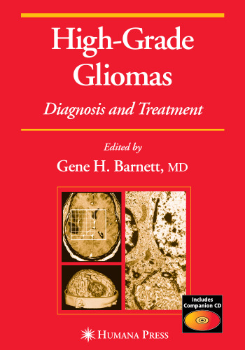 High-Grade Gliomas Diagnosis and Treatment. Current Clinical Oncology