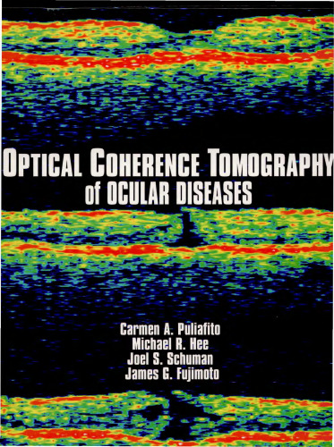Optical Coherence Tomography of Ocular Diseases