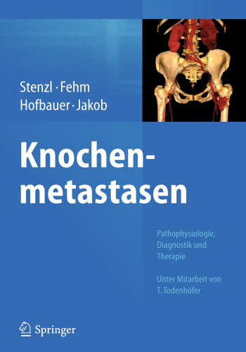 Knochenmetastasen: Pathophysiologie, Diagnostik und Therapie - Unter Mitarbeit von T. Todenhöfer