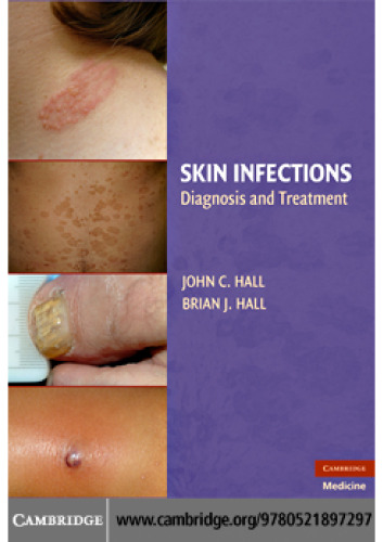 Skin Infections: Diagnosis and Treatment