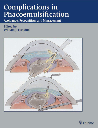 Complications in phacoemulsification : avoidance, recognition, and management