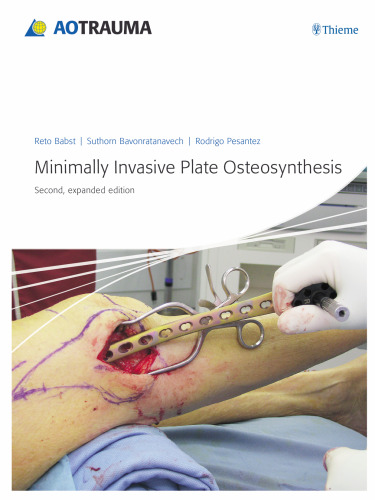 Minimally Invasive Plate Osteosynthesis