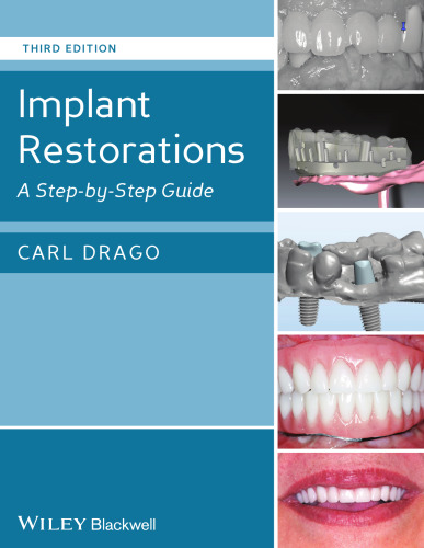 Implant restorations : a step by step guide