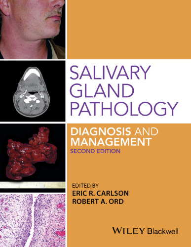 Salivary gland pathology : diagnosis and management