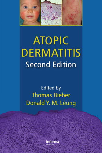 Atopic dermatitis