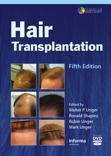 Hair transplantation