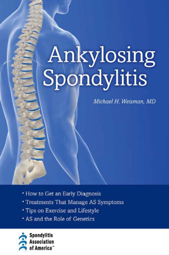 Ankylosing Spondylitis