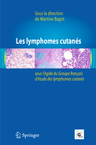 Les lymphomes cutanés: Sous l’égide du Groupe français d’étude des lymphomes cutanés