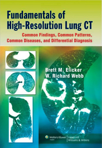 Fundamentals of high-resolution lung CT: common findings, common patterns, common diseases, and differential diagnosis