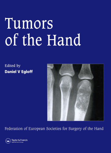 Tumors of the hand