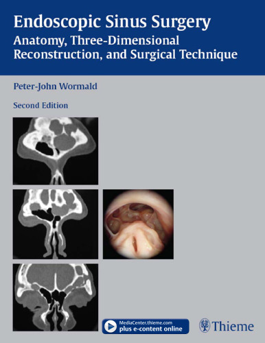 Endoscopic sinus surgery: anatomy, three-dimensional reconstruction, and surgical technique