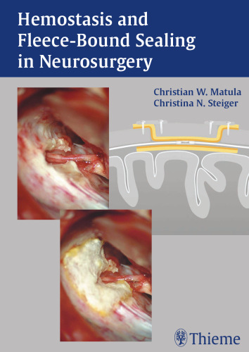 Hemostasis and fleece-bound sealing in neurosurgery