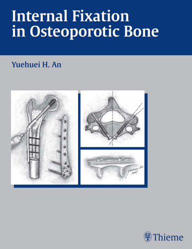 Internal fixation in osteoporotic bone